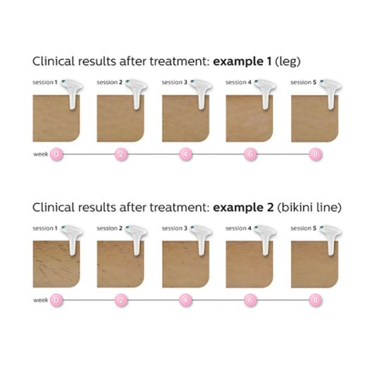 Depiladora IPL LUMEA PHILIPS SC 1997/00